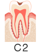虫歯レベル2（C2）