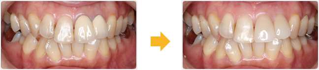 歯茎の黒ずみ治療画像